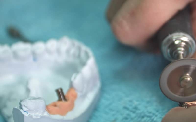dentist shows model of dental prosthesis with implant