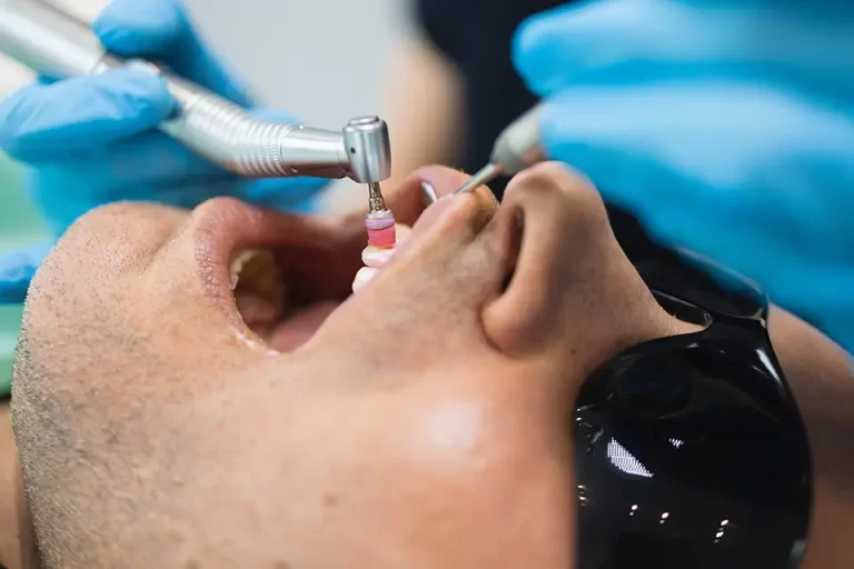 Dental Filling Procedure: Step-by-Step Guide
