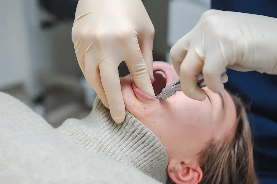 Simple Tooth Extraction: Everything You Need to Know 2 Tooth Extraction Cost in Thornhill: What Affects Pricing