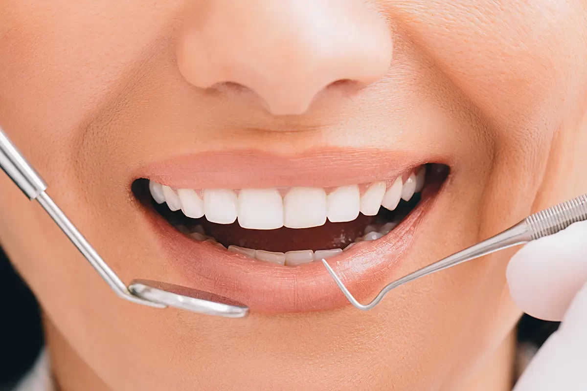 Dental Bonding