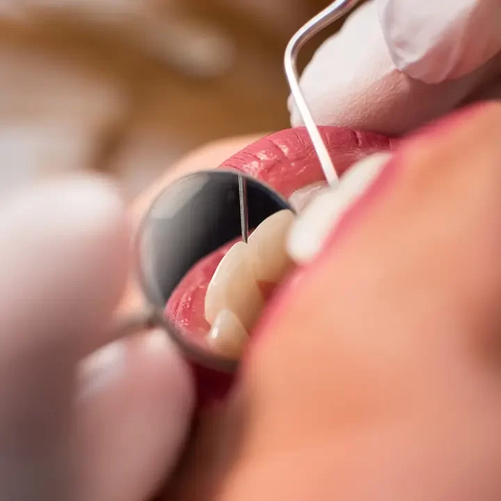 Dental Cleaning