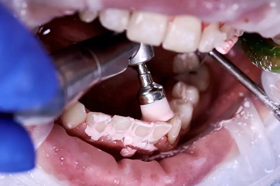 Dental Cleaning