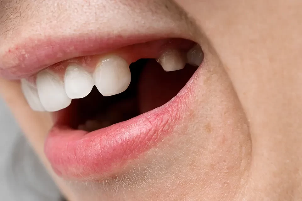 Dental Extraction
