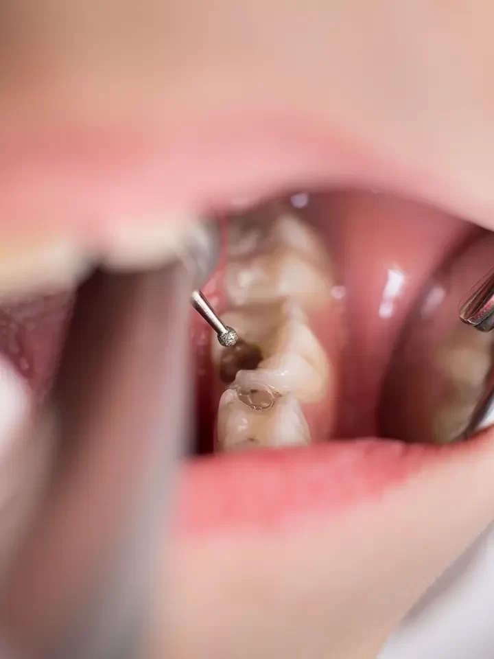 Dental Extraction
