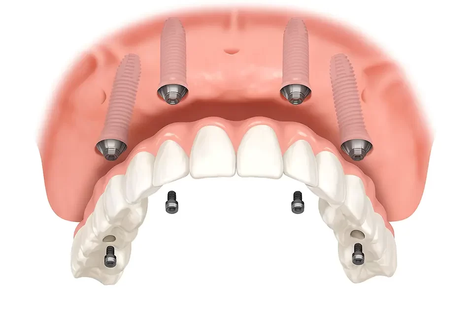 Dental Implants