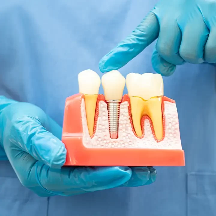 Dental Implants