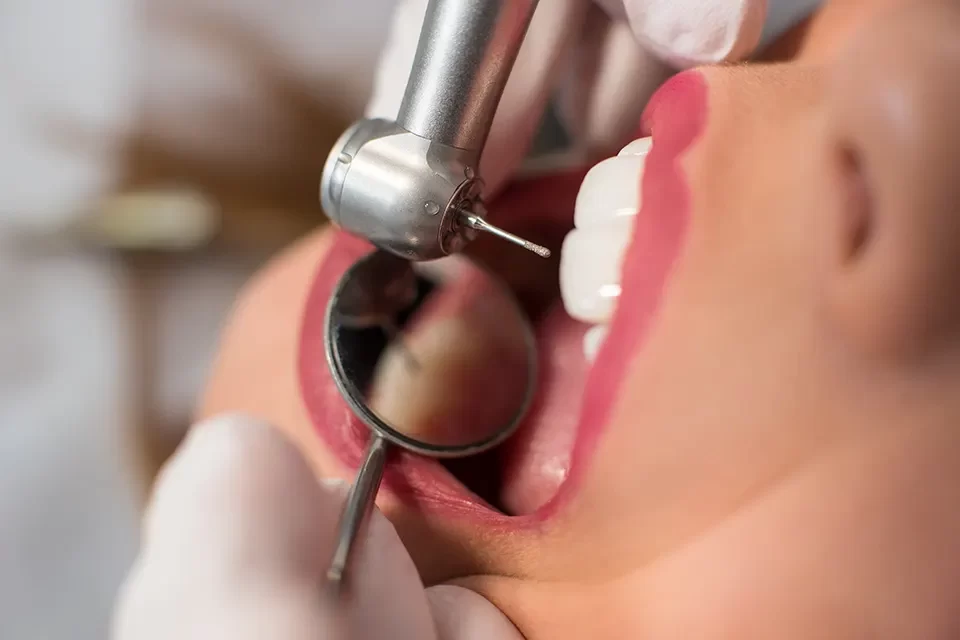 Dental Sealants