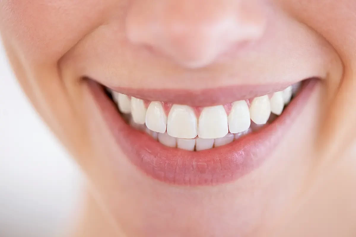 Dental Veneers