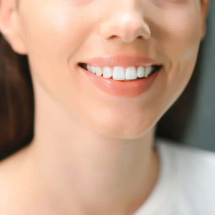 Dental Veneers