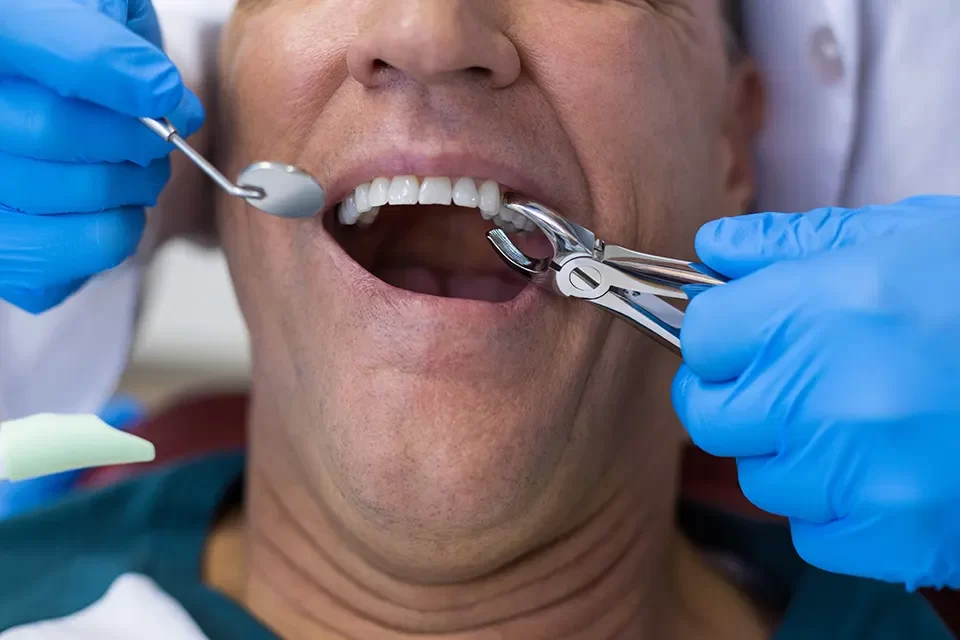 Dental Extraction