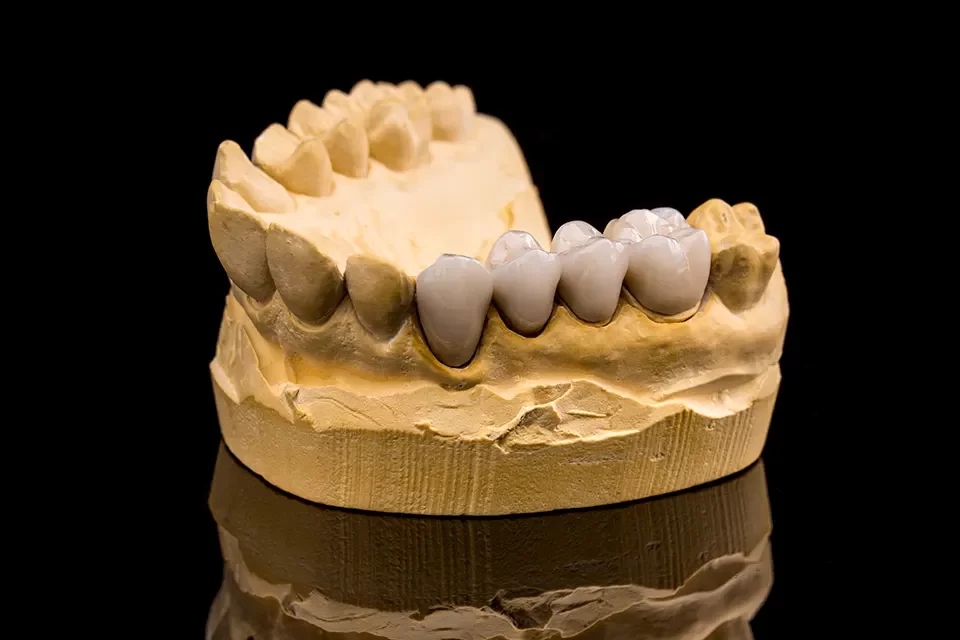 Dental Crowns