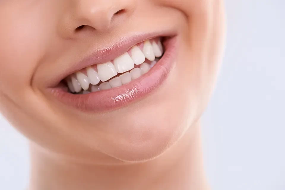 Dental Bridges
