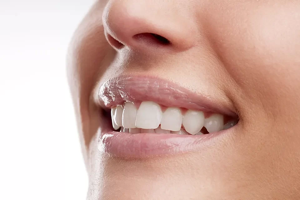 Dental Sealants