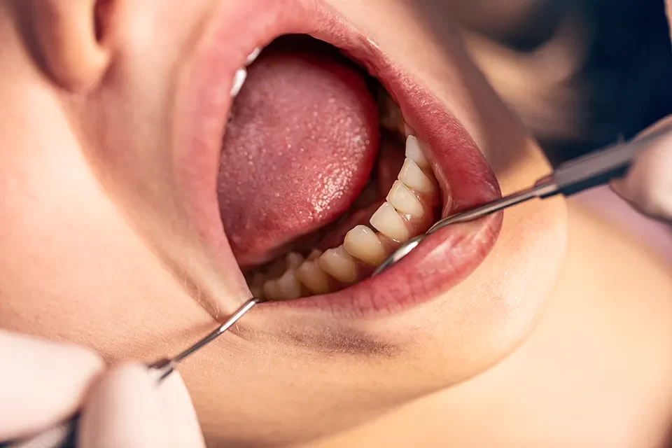 Tongue-Tie Treatment (Frenectomy)