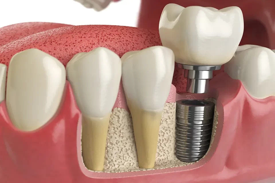 Single Tooth Implants