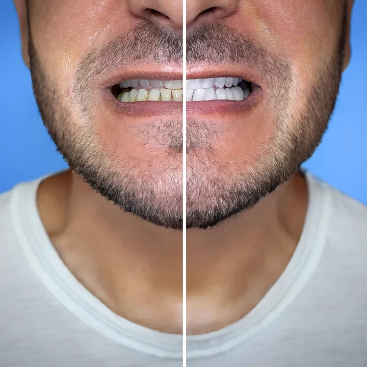 Teeth Whitening