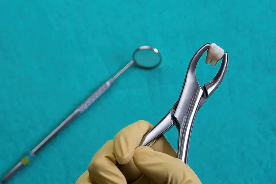 Wisdom Teeth Removal