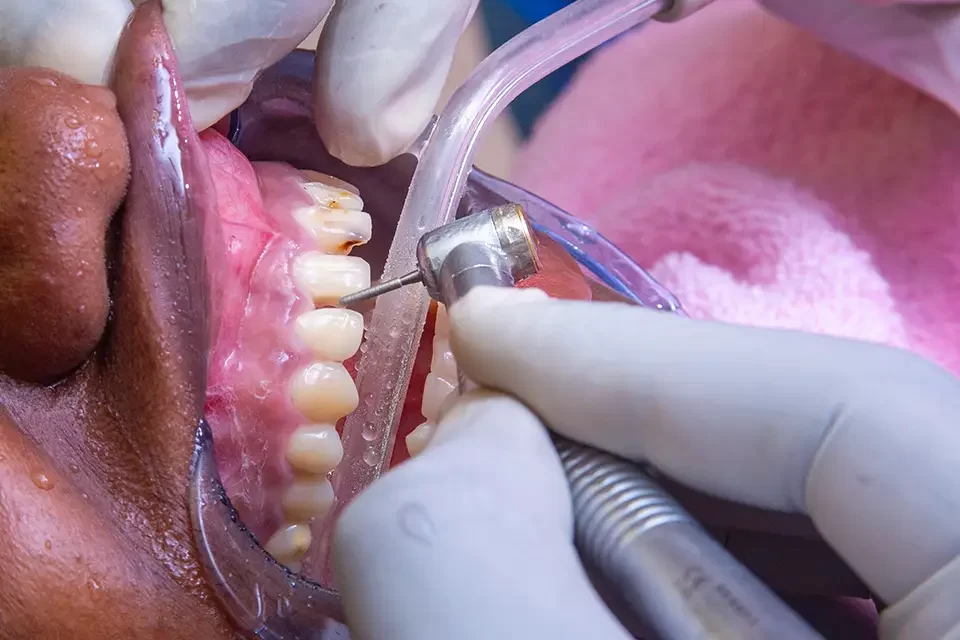 How Often Will You Need Maintenance After a Deep Dental Cleaning Procedure?
